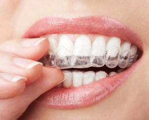 average cost of invisalign wayne nj