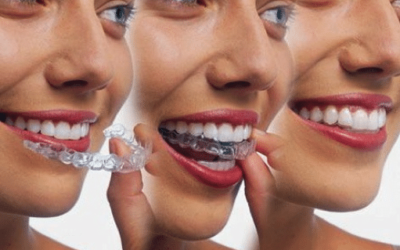 Average Cost Of Invisalign