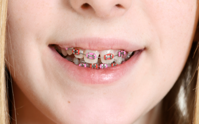 How much do Braces cost?