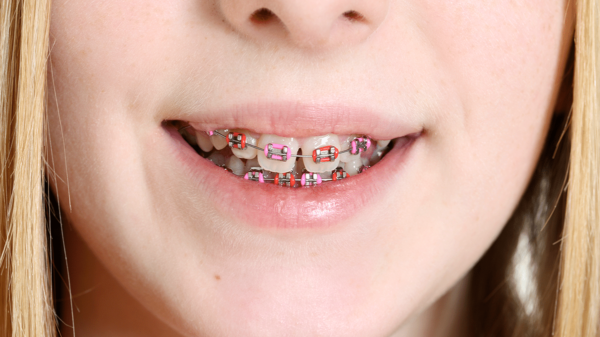 How Much Do Braces Cost? Invisalign vs Metal Braces