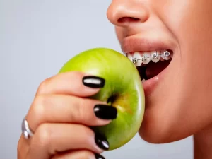 Braces-Friendly Snacks - Smile By Lorino