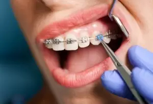 How to Care for Your Dental Braces: Essential Tips for a Smooth Journey